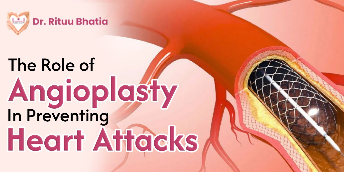 Angioplasty in Preventing Heart Attacks